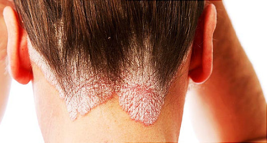 What is Scalp Psoriasis